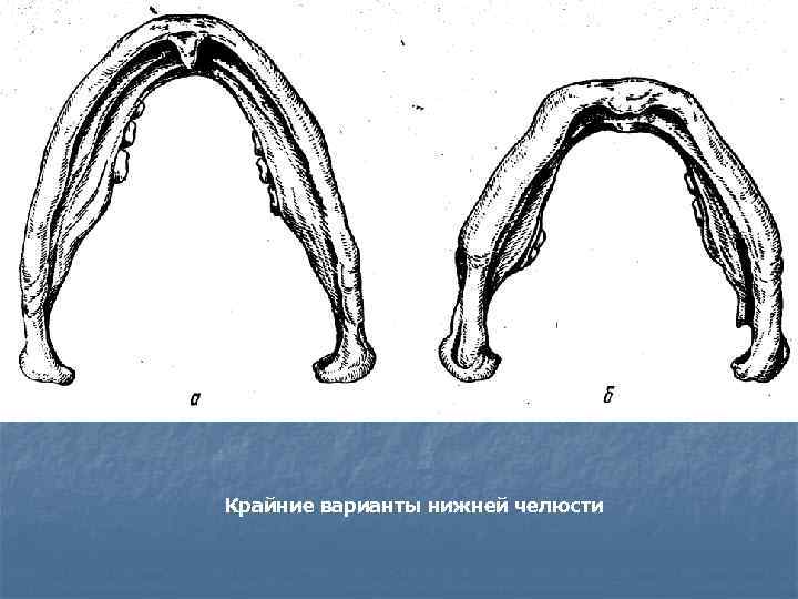 Крайние варианты нижней челюсти 
