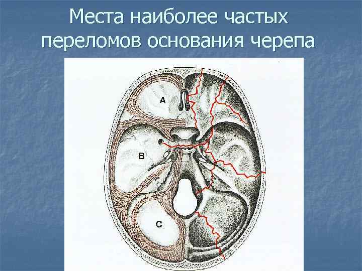 Места наиболее частых переломов основания черепа 