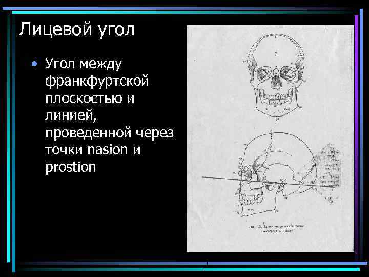 Лицевой угол • Угол между франкфуртской плоскостью и линией, проведенной через точки nasion и