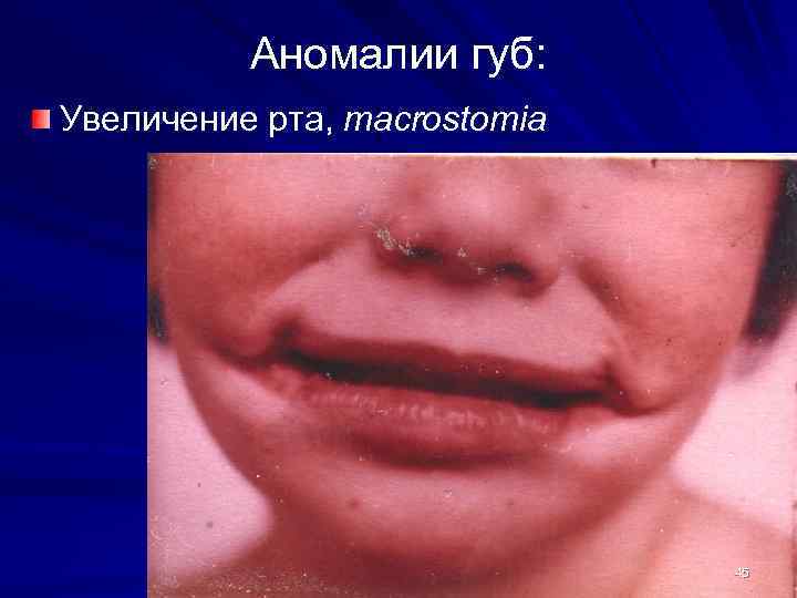 Аномалии губ: Увеличение рта, macrostomia 45 