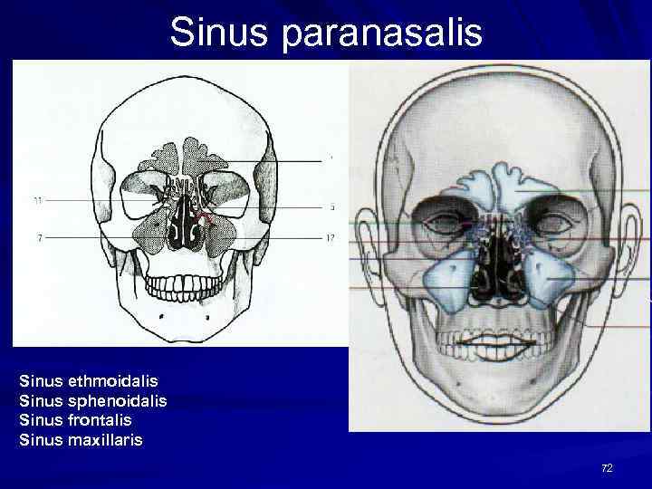 Sinus paranasalis Sinus ethmoidalis Sinus sphenoidalis Sinus frontalis Sinus maxillaris 72 