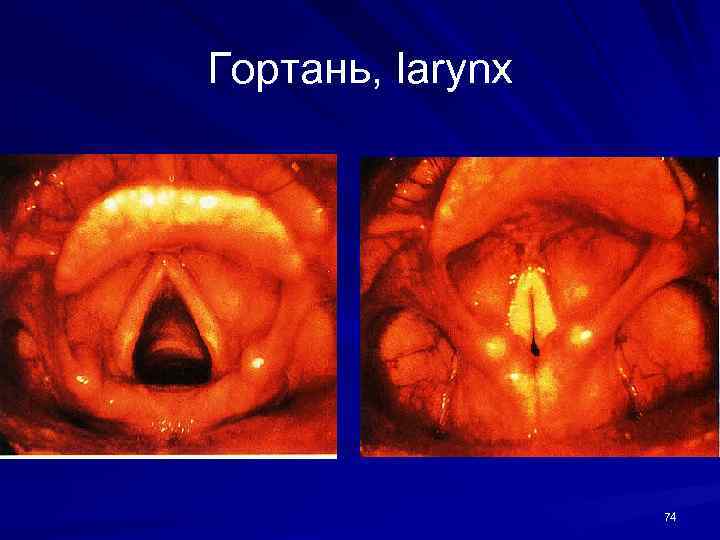 Гортань, larynx 74 