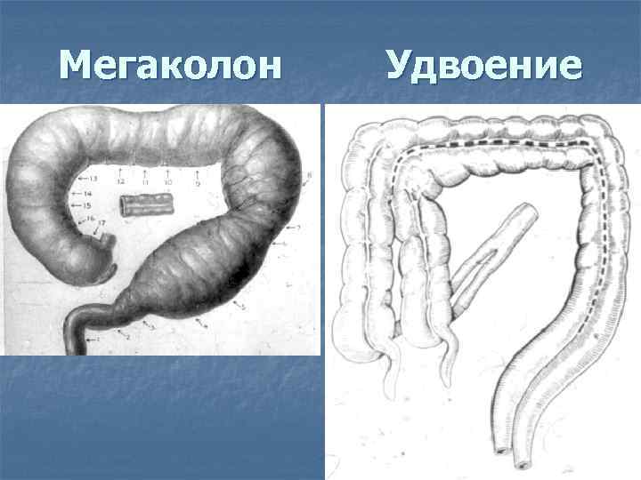 Схема изменений толстой кишки при болезни гиршпрунга