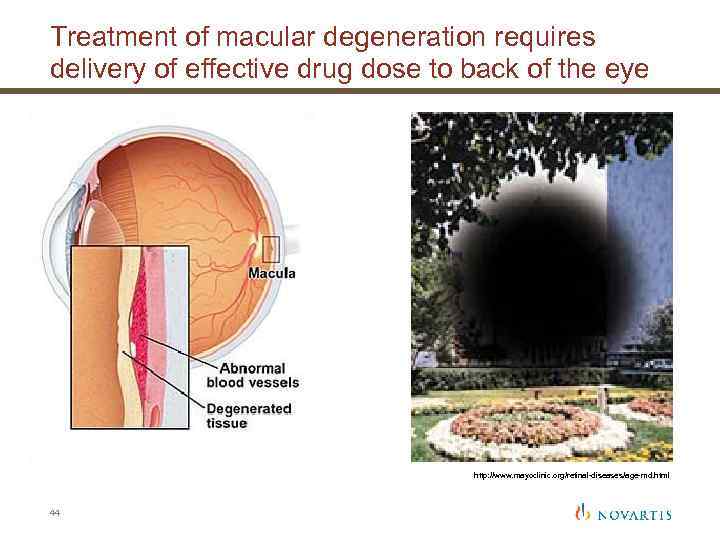 Treatment of macular degeneration requires delivery of effective drug dose to back of the