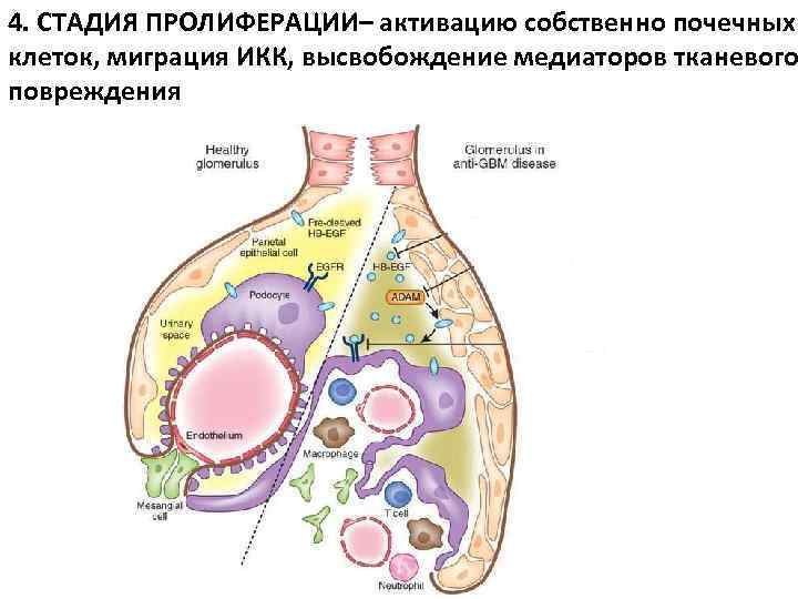 4. СТАДИЯ ПРОЛИФЕРАЦИИ– активацию собственно почечных клеток, миграция ИКК, высвобождение медиаторов тканевого повреждения 