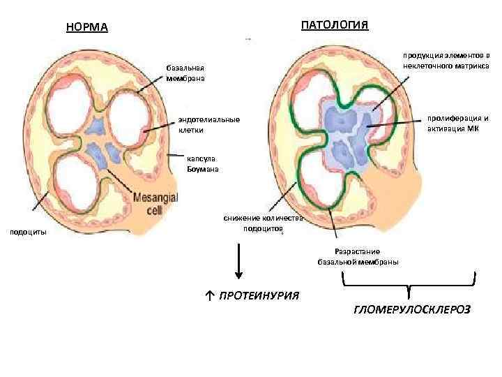 ПАТОЛОГИЯ НОРМА продукция элементов в неклеточного матрикса базальная мембрана пролиферация и активация МК эндотелиальные