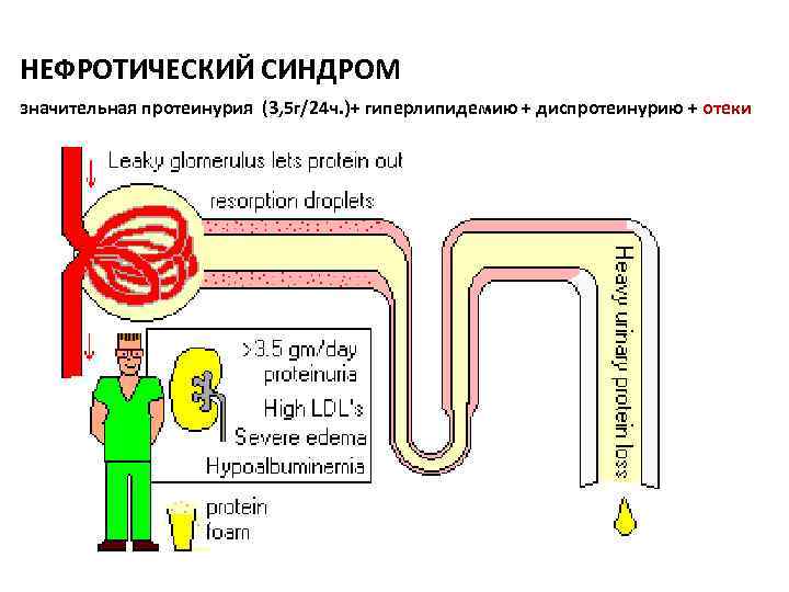 НЕФРОТИЧЕСКИЙ СИНДРОМ значительная протеинурия (3, 5 г/24 ч. )+ гиперлипидемию + диспротеинурию + отеки