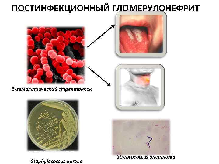 ПОСТИНФЕКЦИОННЫЙ ГЛОМЕРУЛОНЕФРИТ β-гемолитический стрептоккок Staphylococcus aureus Streptococcus pneumonia 