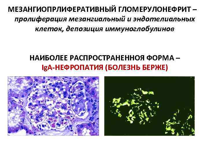 МЕЗАНГИОПРЛИФЕРАТИВНЫЙ ГЛОМЕРУЛОНЕФРИТ – пролиферация мезангиальный и эндотелиальных клеток, депозиция иммуноглобулинов НАИБОЛЕЕ РАСПРОСТРАНЕННОЯ ФОРМА –