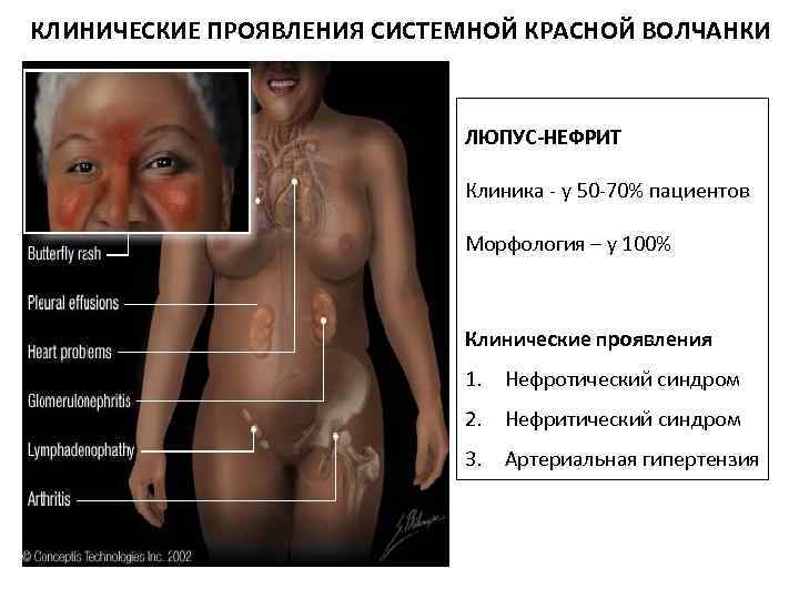 КЛИНИЧЕСКИЕ ПРОЯВЛЕНИЯ СИСТЕМНОЙ КРАСНОЙ ВОЛЧАНКИ ЛЮПУС-НЕФРИТ Клиника - у 50 -70% пациентов Морфология –
