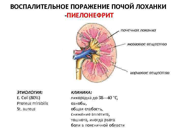 ВОСПАЛИТЕЛЬНОЕ ПОРАЖЕНИЕ ПОЧОЙ ЛОХАНКИ -ПИЕЛОНЕФРИТ почечная лоханка мозговое вещество корковое вещество ЭТИОЛОГИЯ: E. Coli