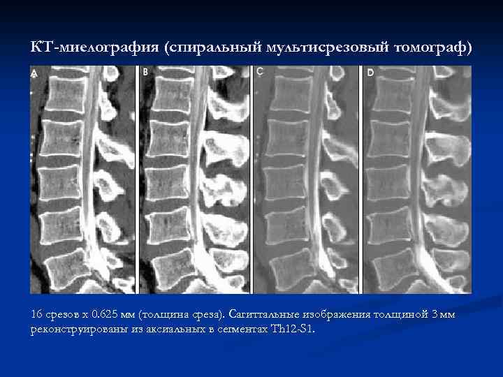 КТ-миелография (спиральный мультисрезовый томограф) 16 срезов x 0. 625 мм (толщина среза). Сагиттальные изображения