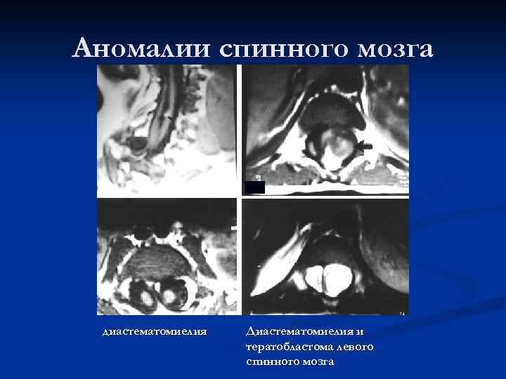 Аномалии спинного мозга диастематомиелия Диастематомиелия и тератобластома левого спинного мозга 