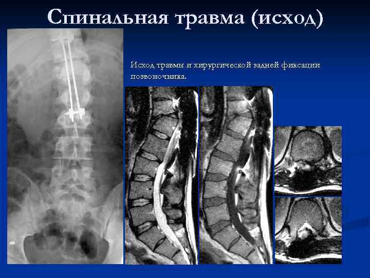 Спинальная травма в свете диагностических изображений