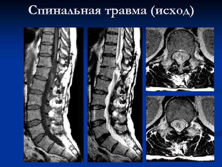 Cпинальная травма (исход) 