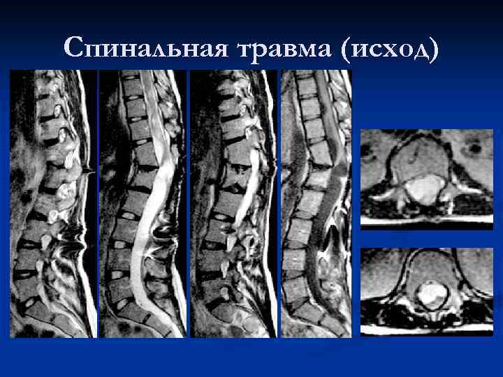 Cпинальная травма (исход) 