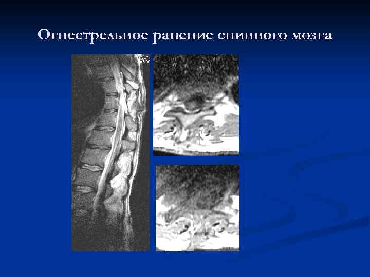 Огнестрельное ранение спинного мозга 
