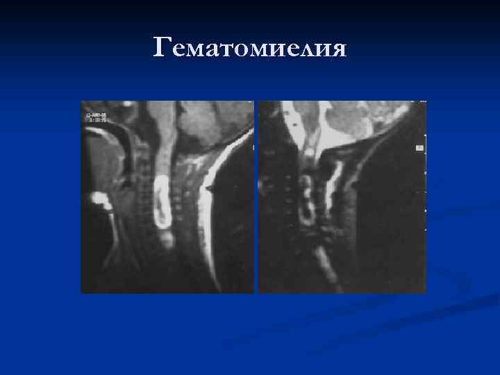 Гематомиелия 