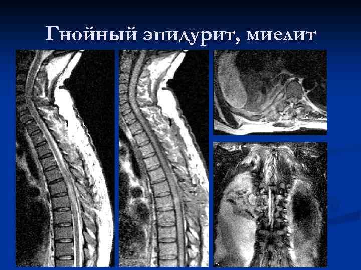 Спинальная травма в свете диагностических изображений