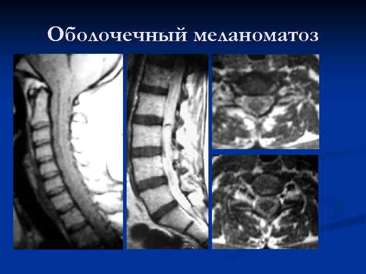 Оболочечный меланоматоз 