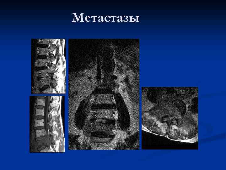 Метастазы 
