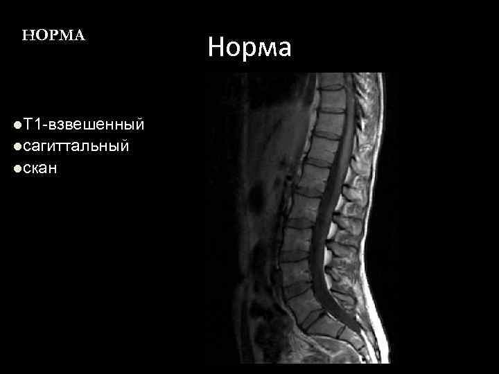 НОРМА l. T 1 -взвешенный lсагиттальный lскан Норма 