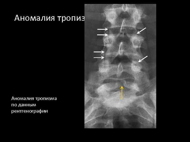 Аномалия тропизма по данным рентгенографии 