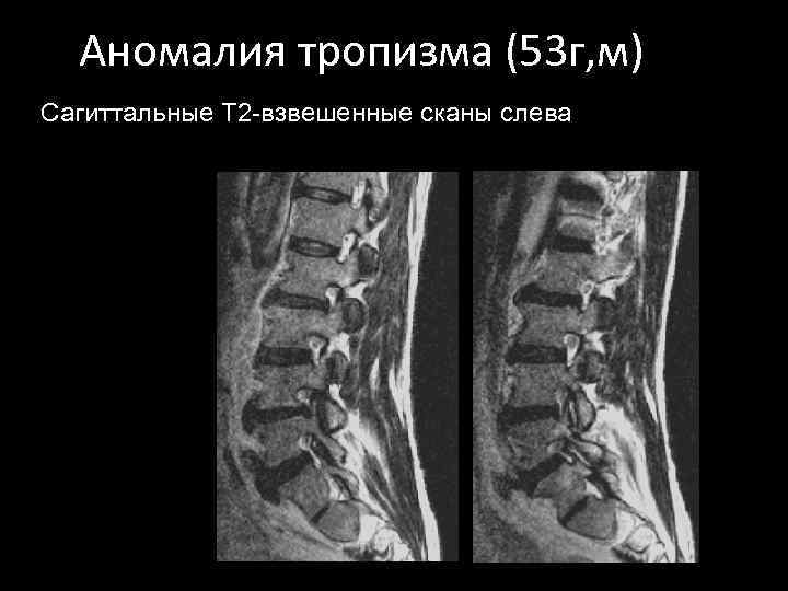 Аномалия тропизма (53 г, м) Сагиттальные Т 2 -взвешенные сканы слева 