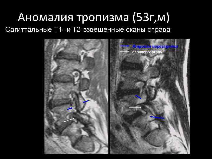 Аномалия тропизма (53 г, м) Сагиттальные Т 1 - и Т 2 -взвешенные сканы