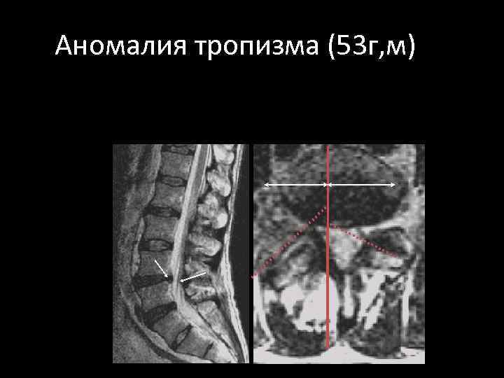 Аномалия тропизма (53 г, м) 