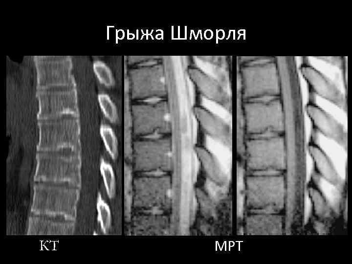 Как лечить грыжу шморля