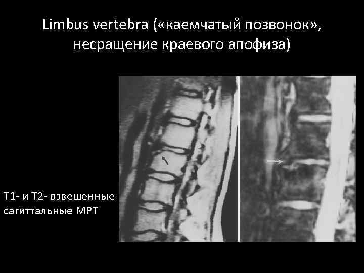 Limbus vertebra ( «каемчатый позвонок» , несращение краевого апофиза) T 1 - и Т