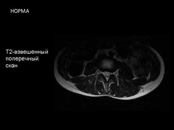 НОРМА T 2 -взвешенный поперечный скан 