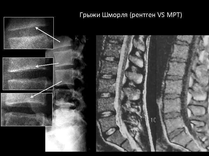 Грыжа шморля как выглядит фото