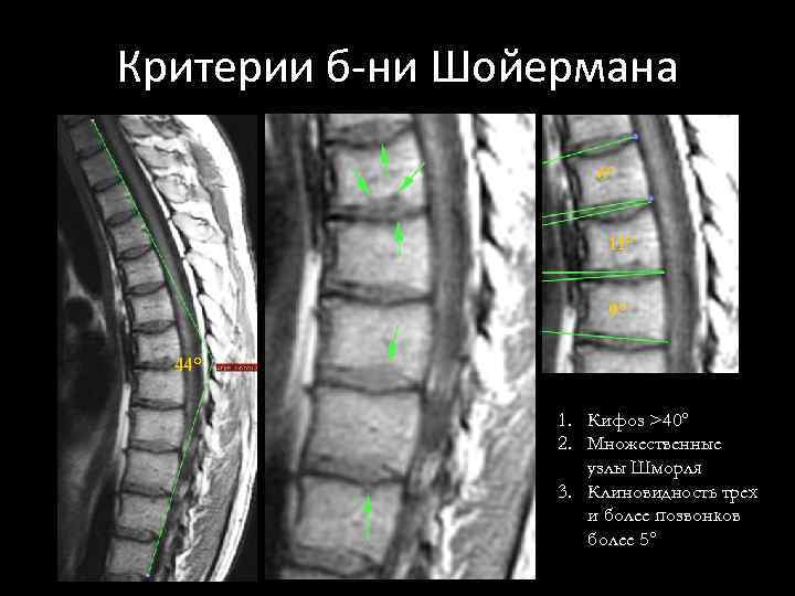 Узелки шморля в позвоночнике. Шморля грыжа на позвоночнике. Узлы Шморля рентген. Множественные узлы Шморля. Острая грыжа Шморля.