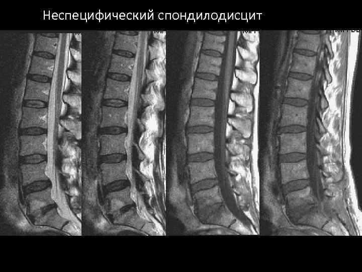 Спондилодисцит мрт картина