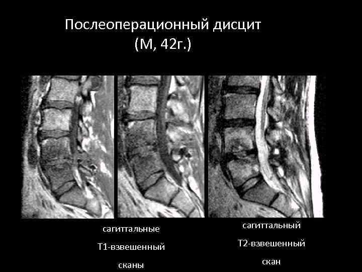 Послеоперационный дисцит (М, 42 г. ) сагиттальные сагиттальный Т 1 -взвешенный Т 2 -взвешенный