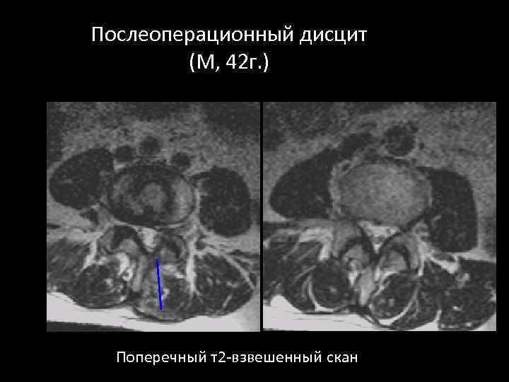 Послеоперационный дисцит (М, 42 г. ) Поперечный т2 -взвешенный скан 