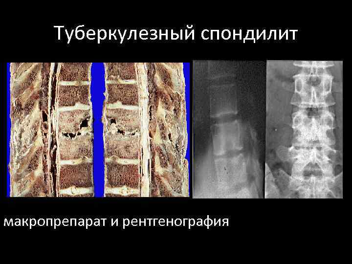 Туберкулезный спондилит макропрепарат и рентгенография 