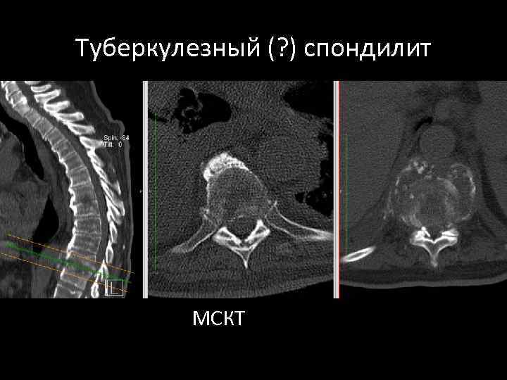 Туберкулезный (? ) спондилит МСКТ 