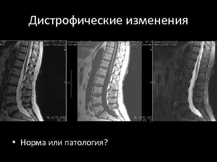 Дистрофические изменения • Норма или патология? 