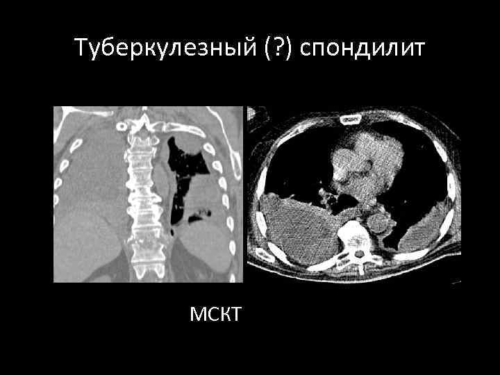 Туберкулезный (? ) спондилит МСКТ 