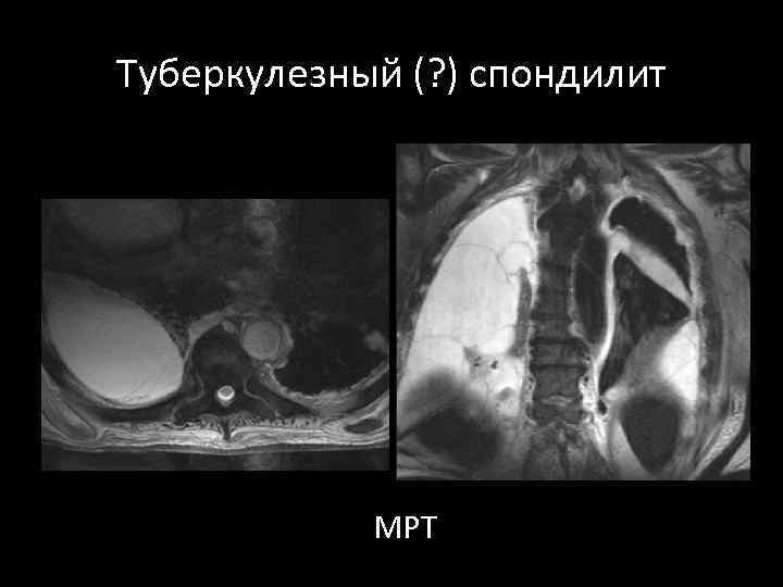 Туберкулезный (? ) спондилит МРТ 