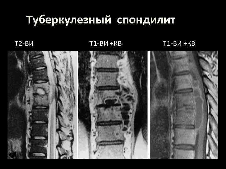 Туберкулезный спондилит Т 2 -ВИ Т 1 -ВИ +КВ 