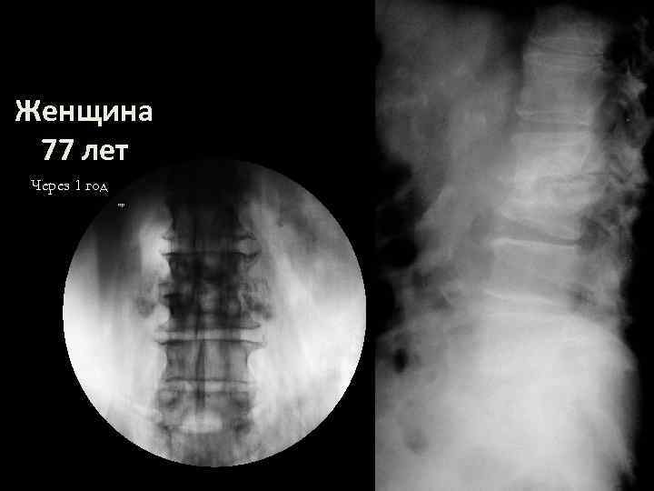 Женщина 77 лет Через 1 год 