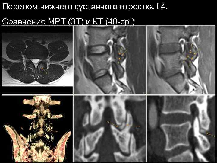 Перелом нижнего суставного отростка L 4. Сравнение МРТ (3 T) и КТ (40 -ср.