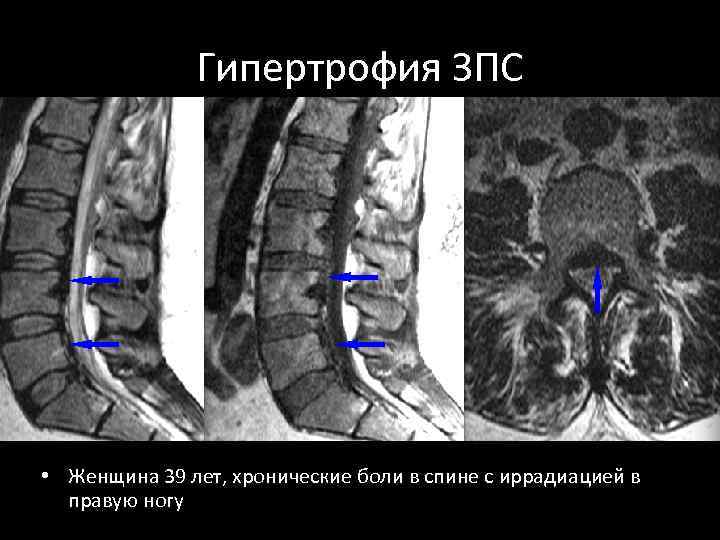 Гипертрофия ЗПС • Женщина 39 лет, хронические боли в спине с иррадиацией в правую