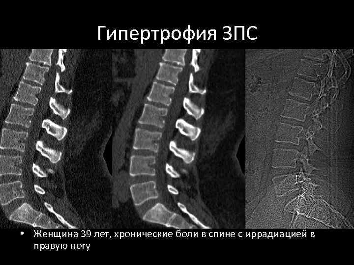 Гипертрофия ЗПС • Женщина 39 лет, хронические боли в спине с иррадиацией в правую