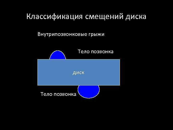 Классификация смещений диска Внутрипозвонковые грыжи Тело позвонка диск Тело позвонка 