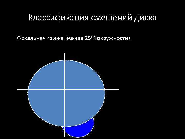 Классификация смещений диска Фокальная грыжа (менее 25% окружности) 